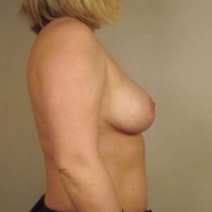 Case--12094 | After Breast 2