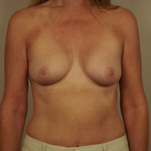 Case--15570 | Before Breast 1