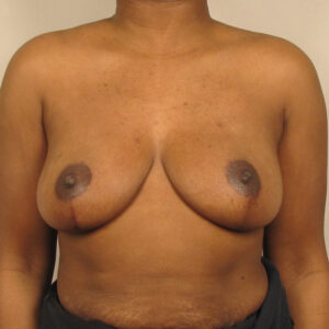 Case--20173 | After Breast 1