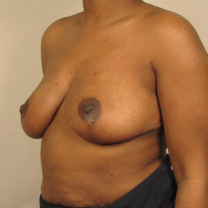 Case--20173 | After Breast 2