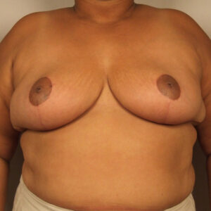 Case--20777 | After Breast 1