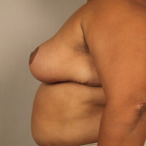 Case--20777 | After Breast 2