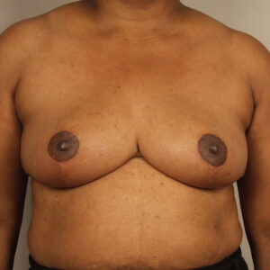 Case--23380 | After Breast 1