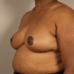 Case--23380 | After Breast 2