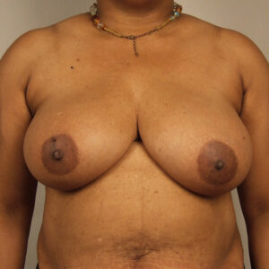 Case--23380 | Before Breast 1
