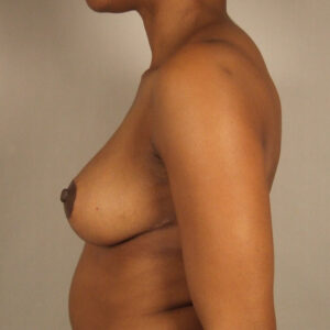 Case--24539 | After Breast 2