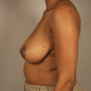 Case--24539 | Before Breast 2