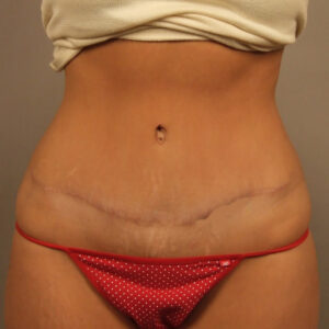 Case--27674 | After Body 1