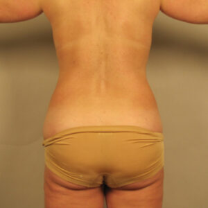 Case--33358 | Before Liposuction 1