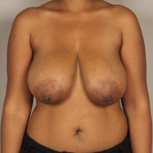 Case--33778 | Before Breast 1