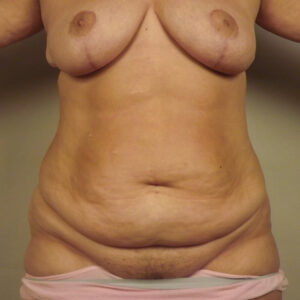 Case--35042 | Before Body 1