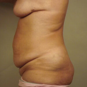 Case--35042 | Before Body 2