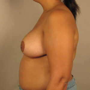 Case--37821 | After Breast 2