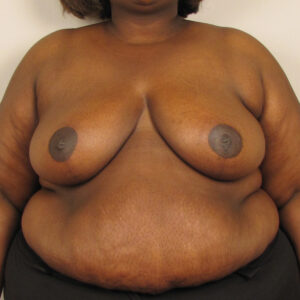 Case--38228 | After Breast 1