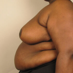 Case--38228 | After Breast 2