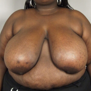 Case--38228 | Before Breast 1