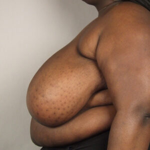 Case--38228 | Before Breast 2