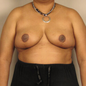 Case--39620 | After Breast 1