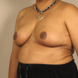 Case--39620 | After Breast 2