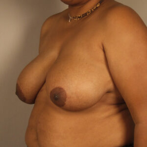 Case--39620 | Before Breast 2