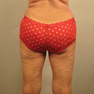 Case--39852 | After Liposuction 1