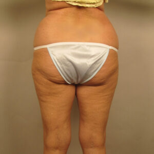 Case--39852 | Before Liposuction 1