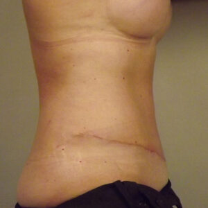 Case--39979 | After Body 2