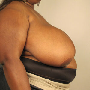 Case--41058 | Before Breast 2