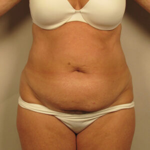 Case--41194 | Before Body 1