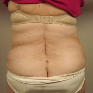 Case--42913 | After Liposuction 1