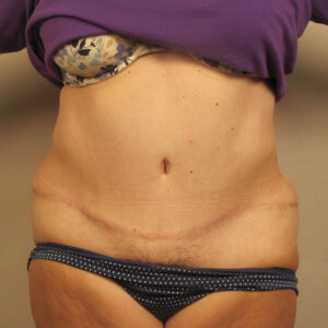 Case--42913 | After Body 1