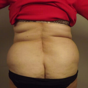 Case--42913 | Before Liposuction 1