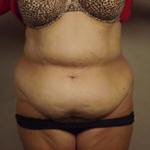 Case--42913 | Before Body 1