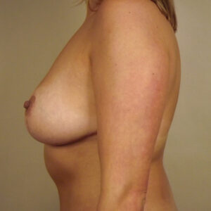 Case--45355 | After Breast Lift (Mastopexy) 2