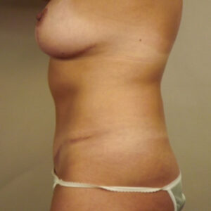 Case--45355 | After Body 2