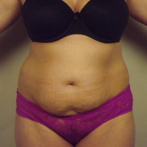 Case--45355 | Before Body 1