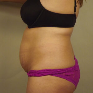 Case--45355 | Before Body 2