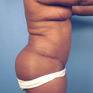 Case--46787 | After Body 2