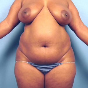 Case--46787 | Before Body 1