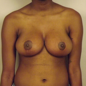 Case--49092 | After Breast 1