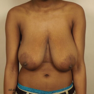 Case--49092 | Before Breast 1