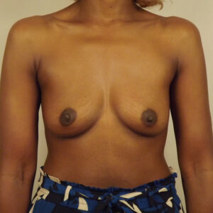 Case--51667 | Before Breast 1