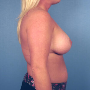 Case--52874 | After Breast Augmentation with Lift (Mastopexy) 2