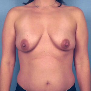 Case--53063 | Before Breast Augmentation with Lift (Mastopexy) 1