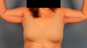Case--57575 | After Dr. Budny 1