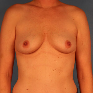 Case--58249 | Before Breast Augmentation with Lift (Mastopexy) 1
