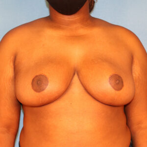 Case--58358 | After Breast 1