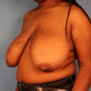 Case--58358 | Before Breast 2