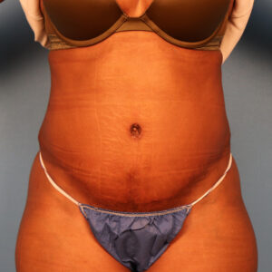 Case--58565 | After Body 1