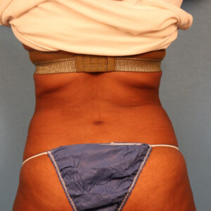 Case--58565 | After Liposuction 1